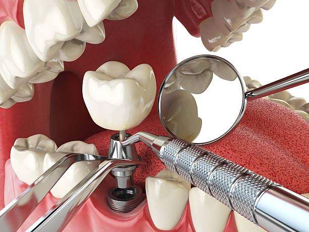 Best Emergency Tooth Extraction in Shadeland, IN